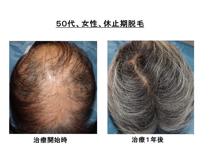 円形脱毛症　病院